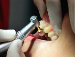 Gigi Berlubang Bisa Menyebabkan Masalah Jantung: Mitos atau Fakta?