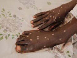 CDC Konfirmasi Kasus Mpox Clade I Pertama di AS
