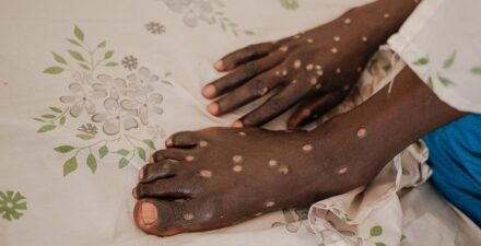 CDC Konfirmasi Kasus Mpox Clade I Pertama di AS