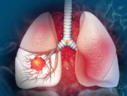 Kanker Paru Stadium 4, Kisah Dr. Bryant Lin yang Tak Merokok