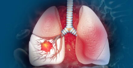 Kanker Paru Stadium 4