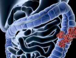 Kanker Kolon Ancam Usia di Bawah 40 Tahun, Kenali Gejalanya Sejak Dini