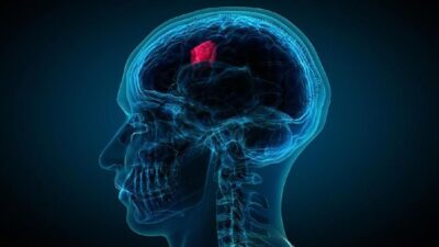 Air Mata Diteliti untuk Deteksi Tumor Otak
